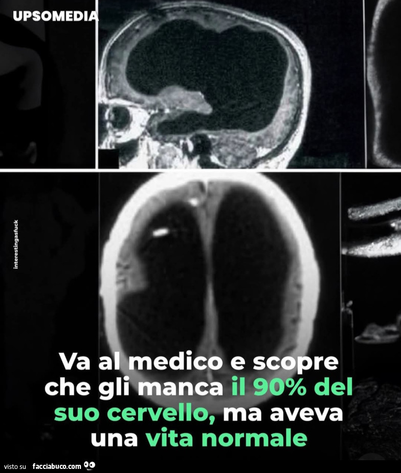 Va dal medico e scopre che gli manca il 90% del suo cervello ma aveva una vita normale