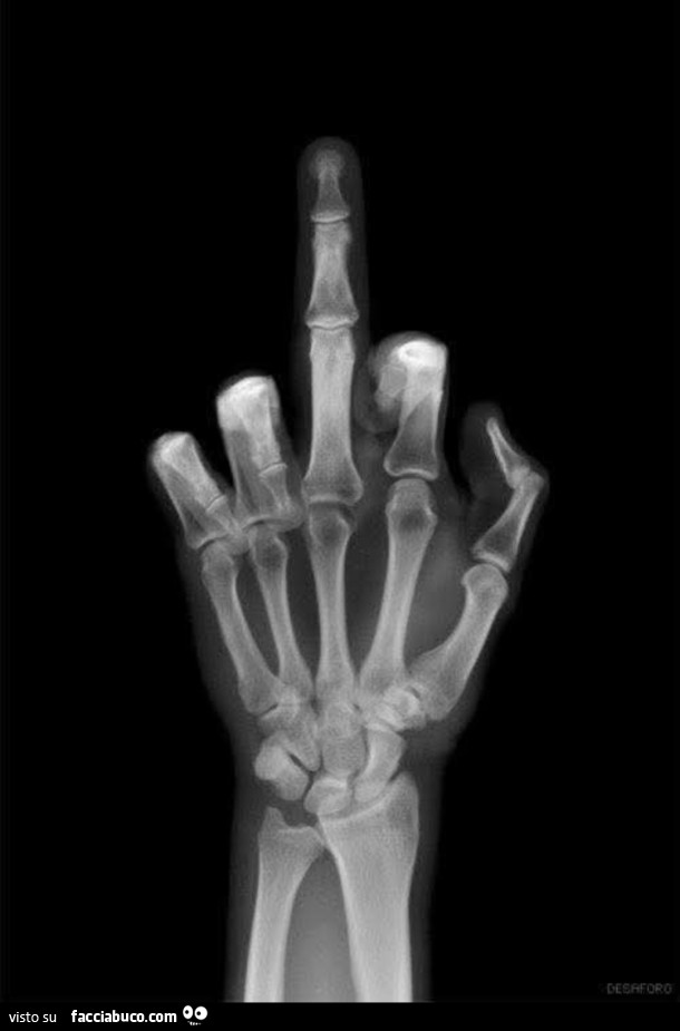 Radiografia dito medio