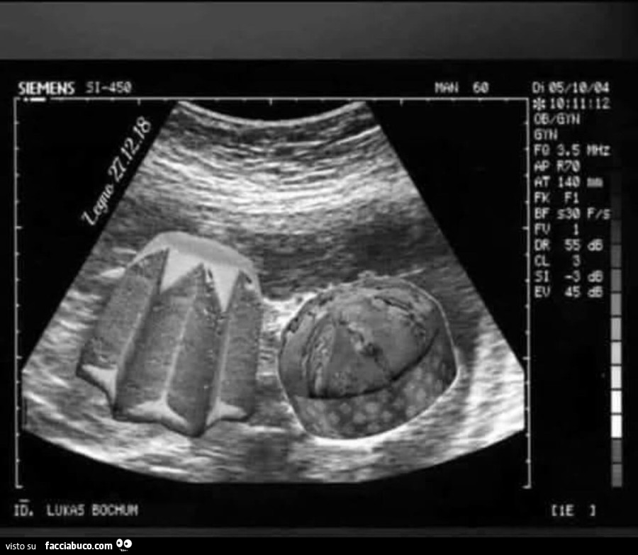 Panettone e Pandoro nell'ecografia