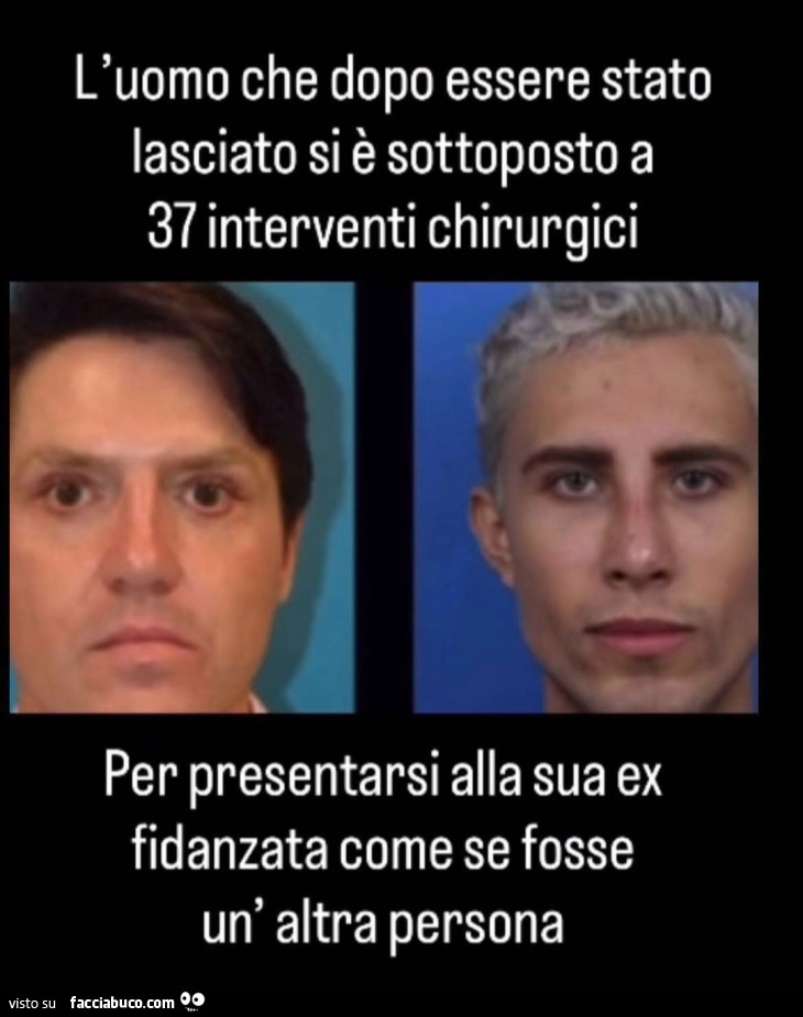 L'uomo che dopo esser stato lasciato si è sottoposto a 37 interventi chirurgici per presentarsi alla sua ex fidanzata come se fosse un'altra persona